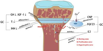 Glucocorticoid induced bone disorders in children: Research progress in treatment mechanisms